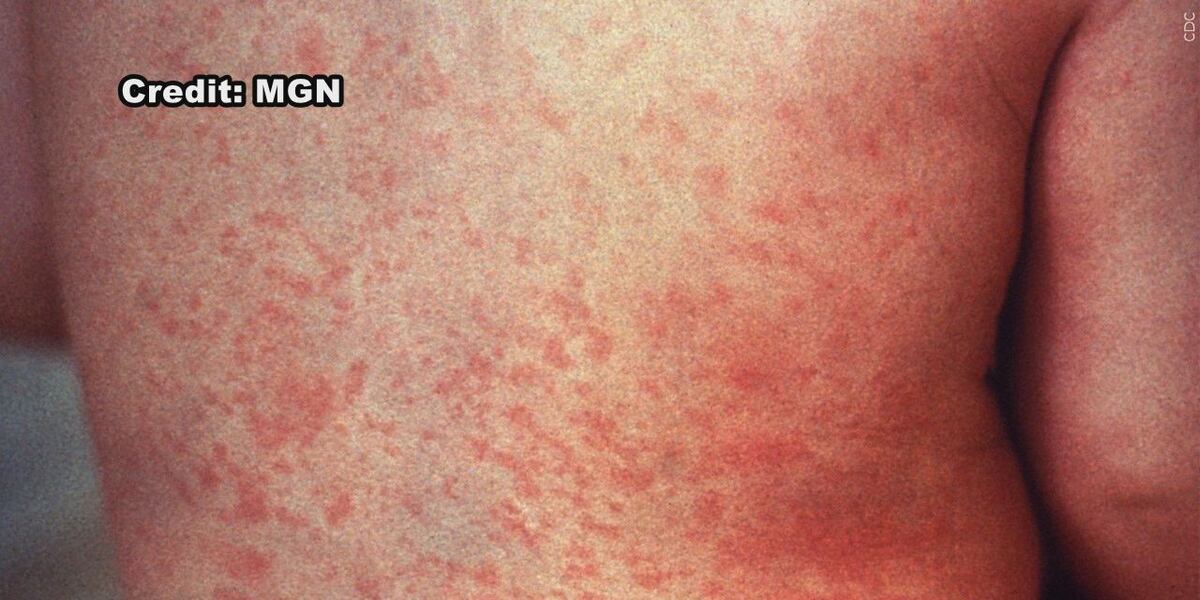 Meesle Type Rash Healthwatch: Dr. Taylor Kapsch speaks on the effects of measles